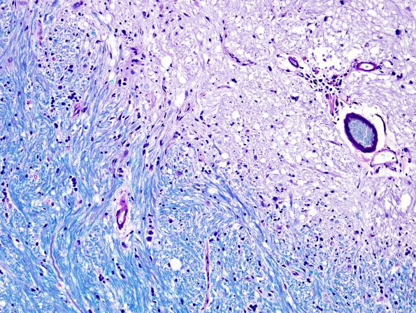 1D3 MS (Case 1) brainstem LFB-PAS 20X