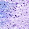 1D5 MS (Case 1) brainstem LFB-PAS 40X