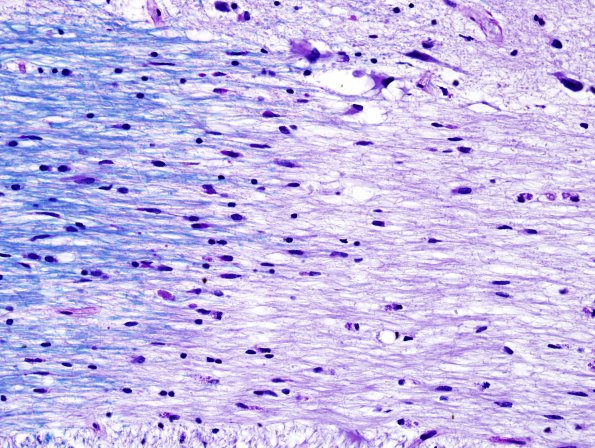 1D5 MS (Case 1) brainstem LFB-PAS 40X