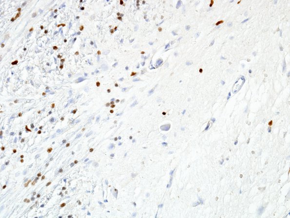 1E1 MS (Case 1) brainstem-basal ganglia Olig 2 1