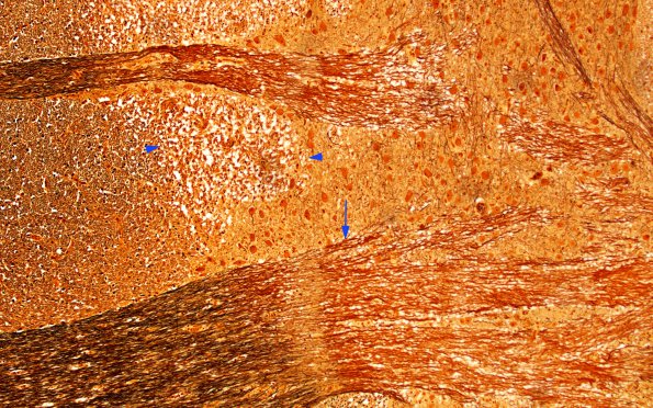 3B6 MS (Case 3) N11 Biels 10X copy