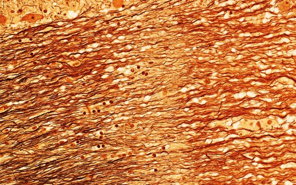 3B8 MS (Case 3) N11 Biels 40X 1