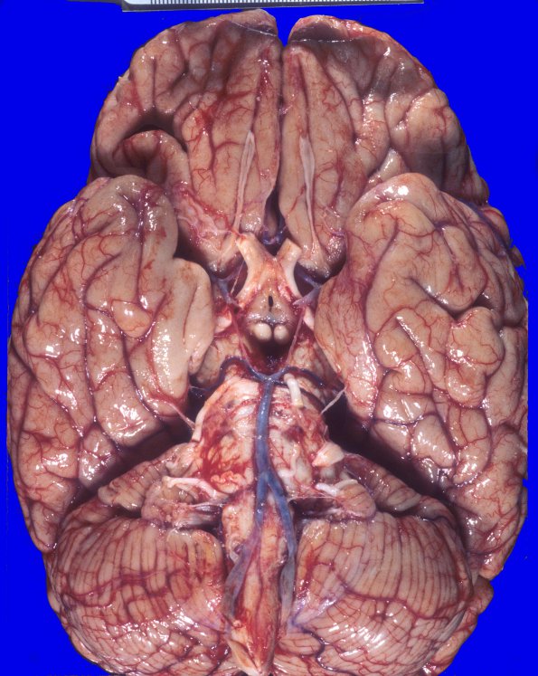 5A1 MS (Case 5) 4A