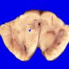 6A1 MS & Gr II Oligoastrocytoma (Case 6) 3 copyA