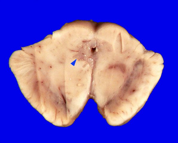 6A1 MS & Gr II Oligoastrocytoma (Case 6) 3 copyA