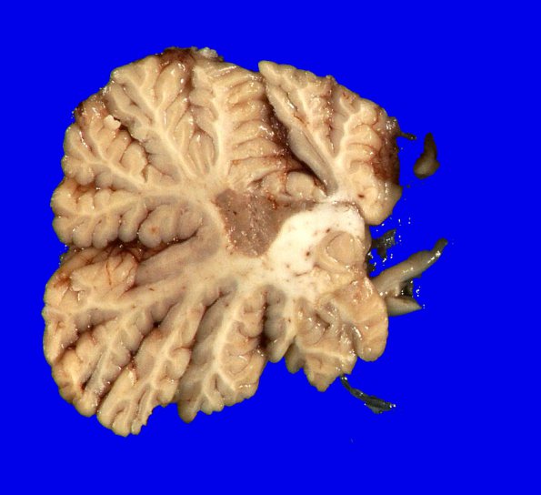 6A2 MS & Gr II Oligoastrocytoma (Case 6) 5A