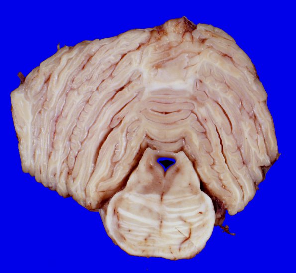 8A1 Multiple Sclerosis (Case 8) 7A