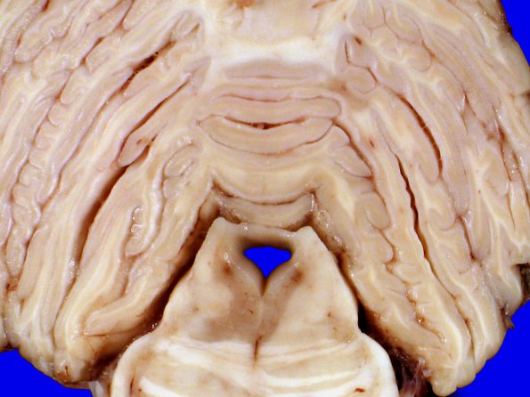 8A2 Multiple Sclerosis (A06-133) 8A