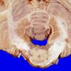 8A4 Multiple Sclerosis (Case 8) 2A