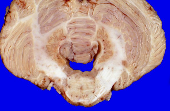 8A4 Multiple Sclerosis (Case 8) 2A