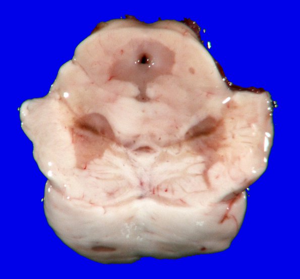 9A1 Multiple Sclerosis (Case 9) 6A