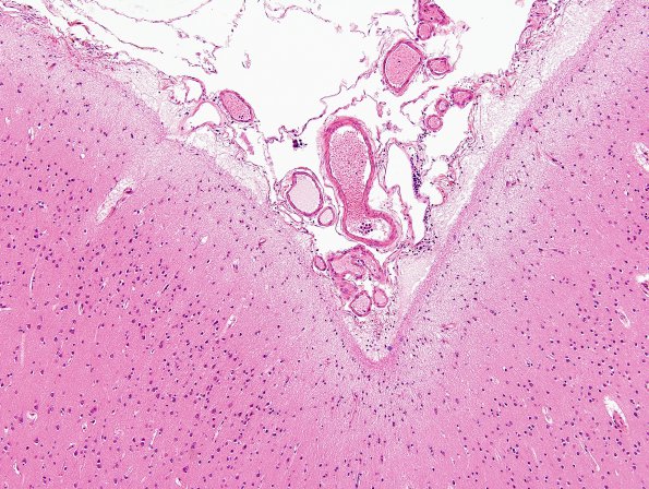 1C7 MS (Case 1) Cort Plaques (block A24) H&E 1