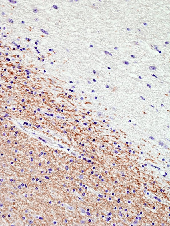 1E4 MS (Case 1) Cort Plaques 40X MBP match with NF