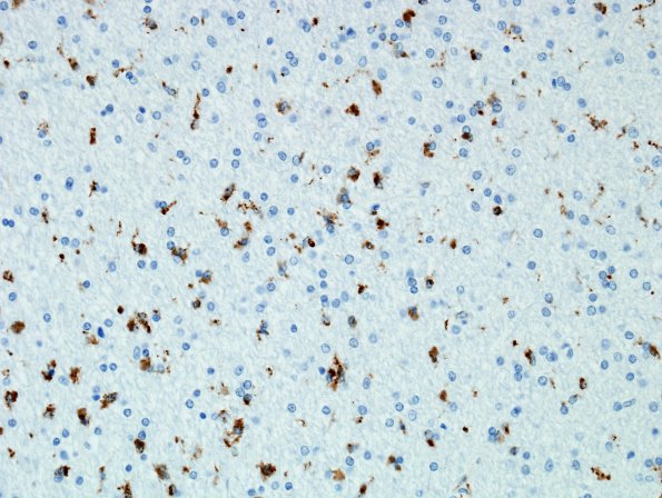 1G4 MS (Case 1) Cort Plaques CD68 1 (adjacent white matter)