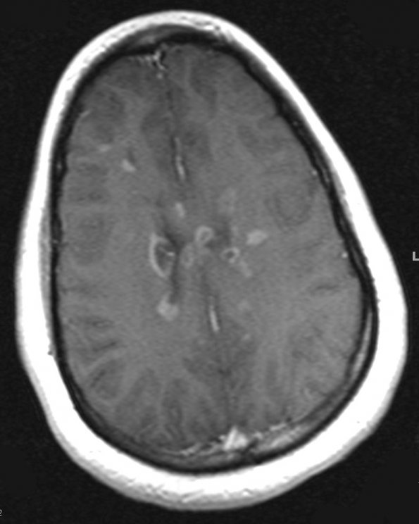 2A1 MS (Active Lesions) (Case 2) T1 Post-Contrast - Copy