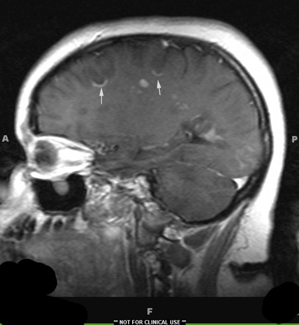 2A2 MS Shadow & Cortical Plaques (Case 2) T1 W - Copy copy