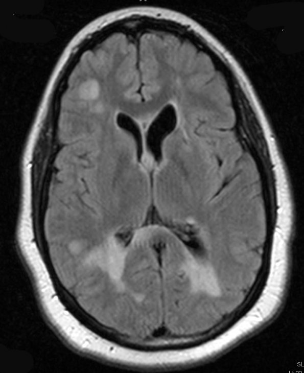 2A3 MS (Active Lesions) (A12-56) T2 4 (dark fluid) - Copy