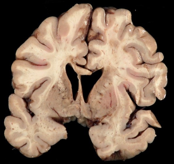 2B1 MS Shadow & Cortical Plaque (Case 2) B _2