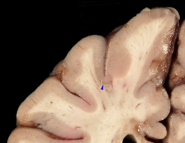 2B2 MS Shadow & Cortical Plaque (Case 2) B _2 copy