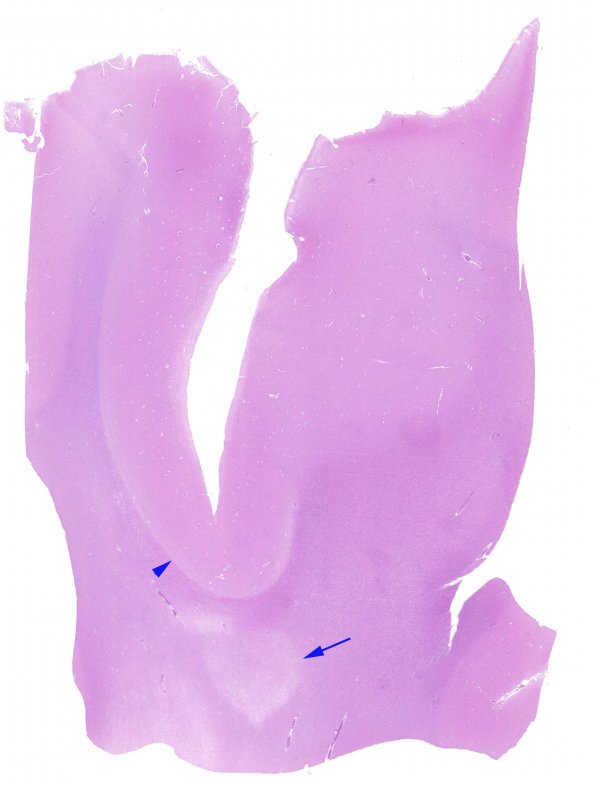 2C1 MS Shadow & Cortical Plaque (Case 2) area A1 N1 H&E whole mount correlate A copy
