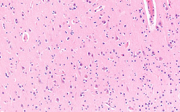 2C2 MS Cortical Plaque (Case 2) from PLP absent area H&E 20X 1