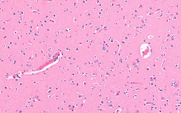 2C2 MS Cortical Plaque (Case 2) from PLP intact area H&E 20X 1