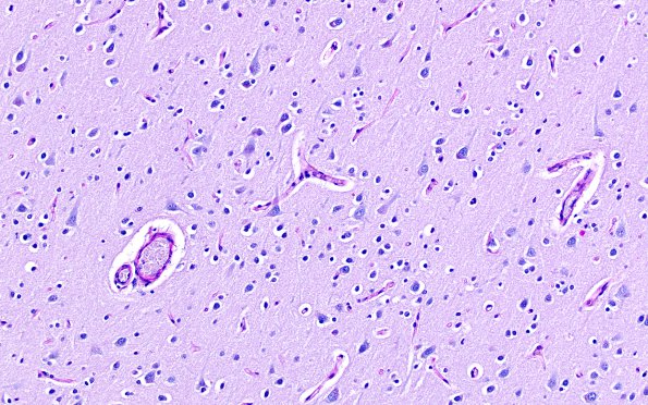 2D2 MS Cortical Plaque (Case 2) from PLP absent area LFB-PAS 20X 1