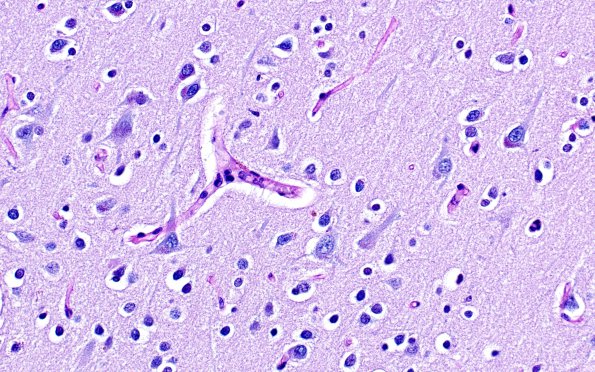 2D4 MS Cortical Plaque (Case 2) from PLP absent area LFB-PAS 40X 1