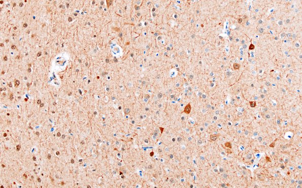 2H MS Cortical Plaque (Case 2) from PLP absent area NF 20X 1