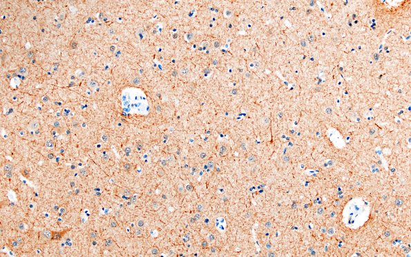 2H2 MS Cortical Plaque (Case 2) from PLP intact area NF 20X 1