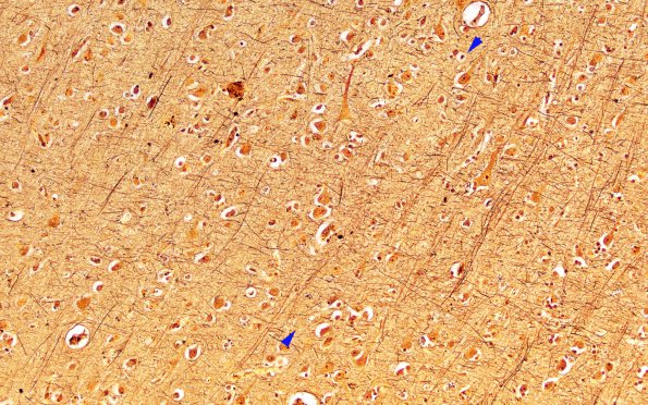 2H MS Cortical Plaque (Case 2) from PLP junction area Biels 20X 1 copy