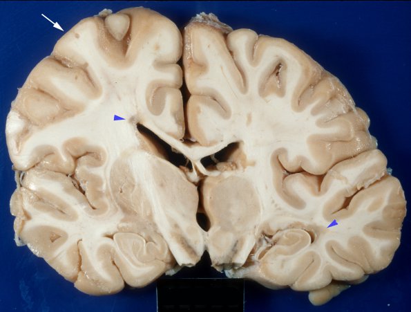 3A1 MS, Cortical Plaque (Case 3) 7A copy