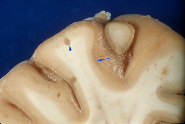 3A2 MS, Cortical Plaque (Case 3) 7 original copy