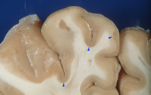 3A3 MS, Cortical Plaque (Case 3) 1 copy