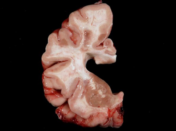 4A1 Multiple Sclerosis (SPMS, Case 4) cortical plaques 2