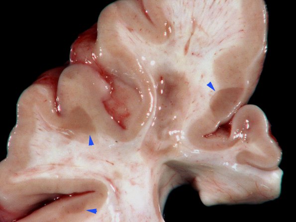 4A2 Multiple Sclerosis (SPMS, Case 4) cortical plaques 3 copy