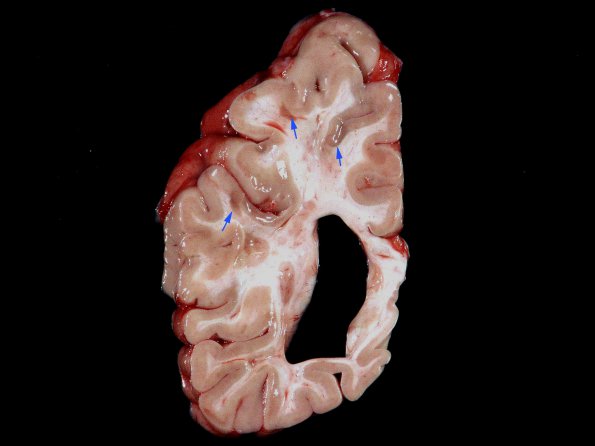 4A3 Multiple Sclerosis (SPMS, Case 4) cortical plaques 1 copy