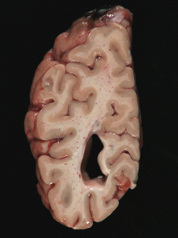 5A1 MS, cortical plaques (Case 5) Gross 9