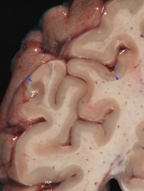 5A2 MS, cortical plaques (Case 5) Gross 4 copy copy