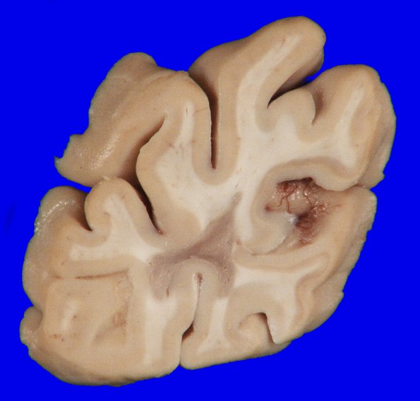 10A2 Multiple Sclerosis (Case 10) 3A