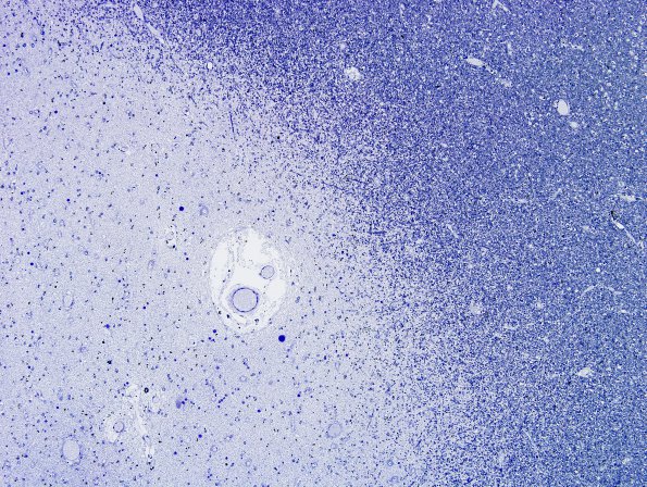 10B1 Multiple Sclerosis (Case 10) Plastic 6 (Plaque edge 3)