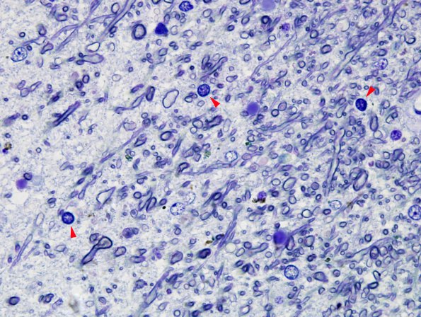 10B2 Multiple Sclerosis (Case 10) Plastic 6 (Plaque edge) copy