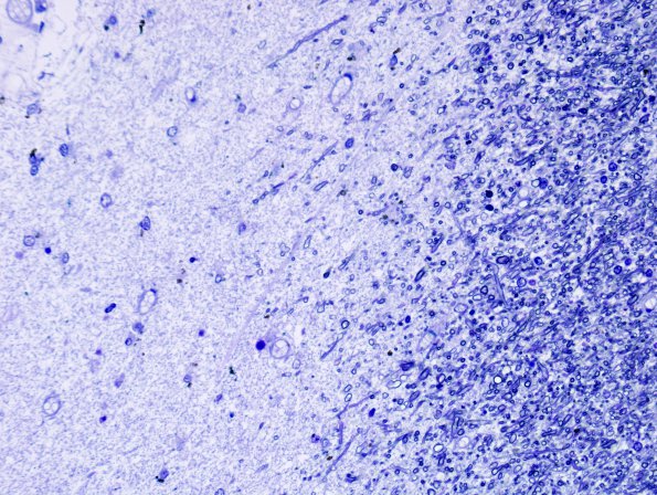 10B3 Multiple Sclerosis (Case 10) Plastic 4