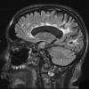 11A1 Multiple Sclerosis (Case 11) T2 FLAIR (2) - Copy