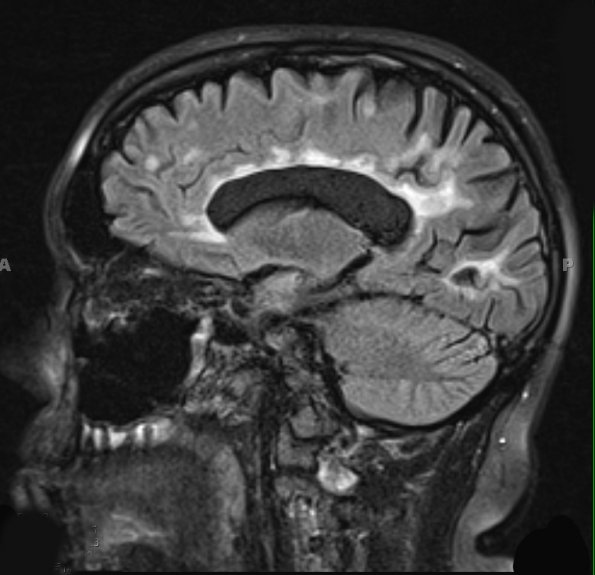 11A1 Multiple Sclerosis (Case 11) T2 FLAIR (2) - Copy