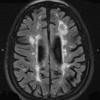 11A2 Multiple Sclerosis (Case 11) T2 FLAIR (3) - Copy