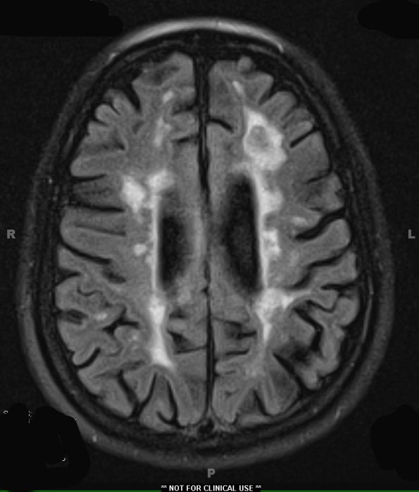 11A2 Multiple Sclerosis (Case 11) T2 FLAIR (3) - Copy