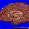 11B1 Multiple Sclerosis (Case 11) 1A copyA