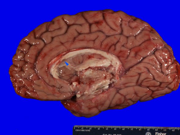 11B1 Multiple Sclerosis (Case 11) 1A copyA