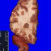 11B3 Multiple Sclerosis (Case 11) 6A